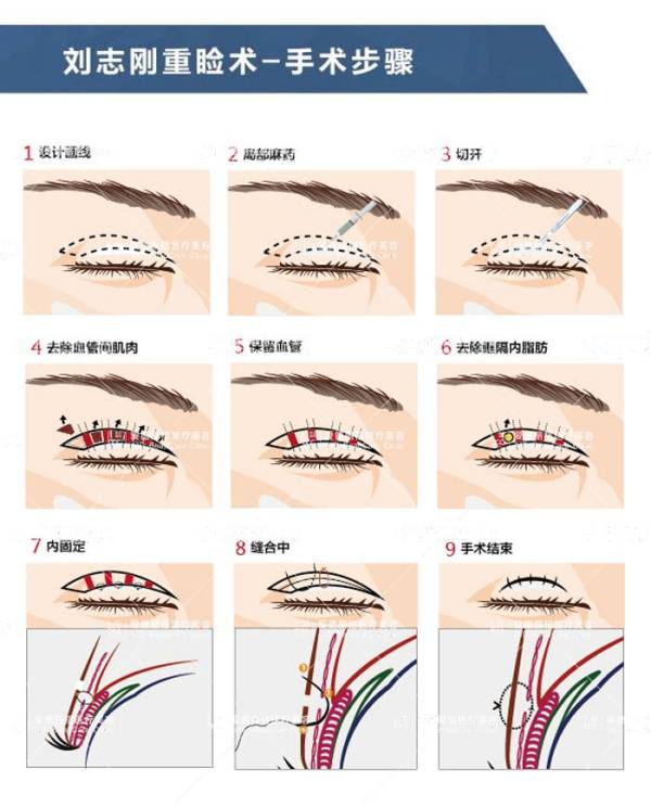 大连爱德刘志刚重睑术