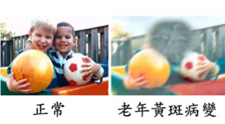 老年黄斑病变.png
