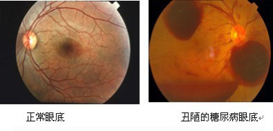 眼底出血1.jpg