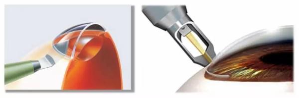 超9成的人眼睛可能患有散光，昆明眼科医院：散光三种治疗方式