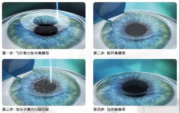 深圳希玛眼科医院：两类近视人群一定要避开近视激光类手术