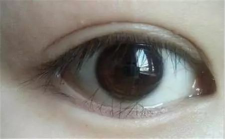深圳希玛眼科:孩子眼睫毛倒着长,能自己拔掉吗?千万别!
