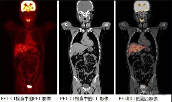 pet/ct究竟是什么?寻药宝典带你深入了解