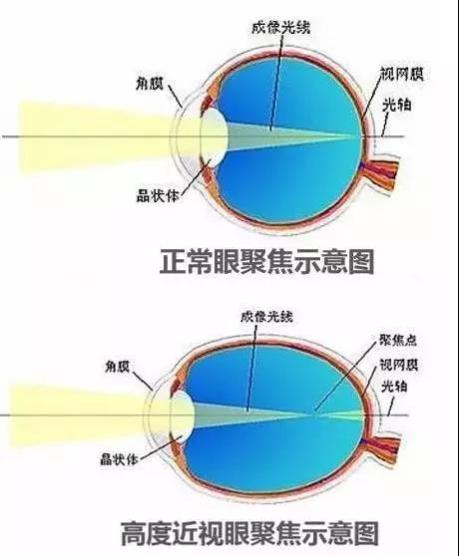 2.0视力度数多少度,2.0视力是多少度