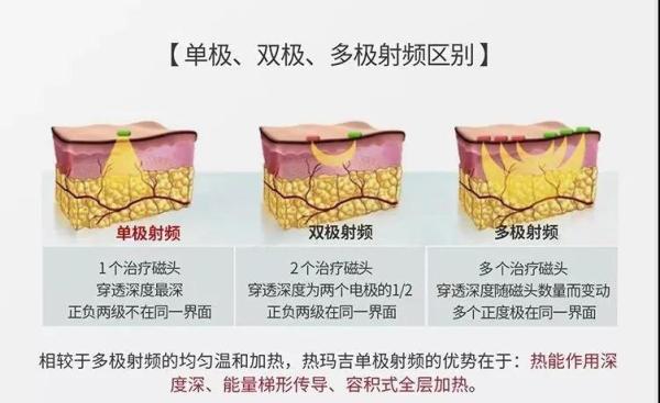 从技术原理来看,第四代热玛吉thermage cpt跟新一代热玛吉thermage