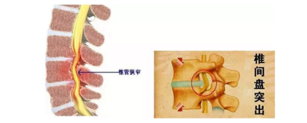 腰椎管狭窄症的几个特殊症状你肯定忽视过